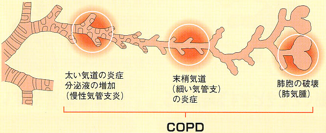 肺気腫 慢性