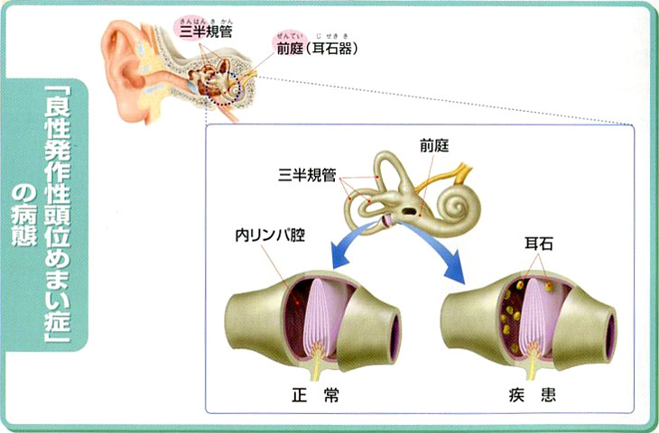 良性 発作 性 頭 位 めまい 症 治療